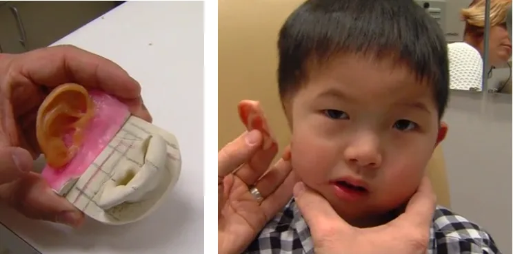 New Prosthetic Ear Thanks to 3D Printing