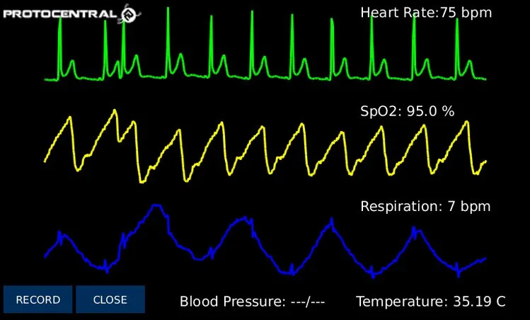 HealthyPi v3 – The Open Source Vital Sign Monitoring HAT for Raspberry Pi
